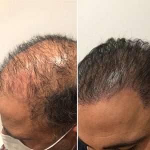 Professional SMP hair restoration treatment in Bristol