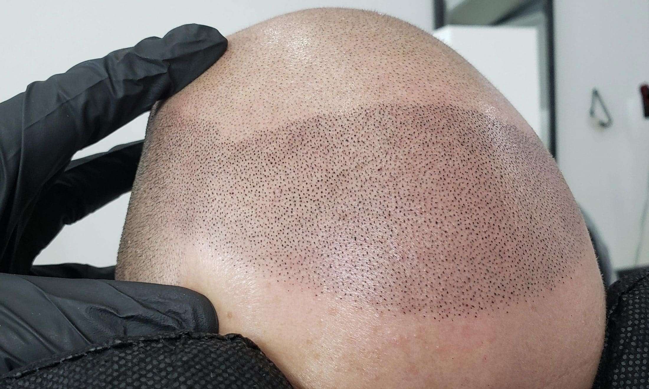 scalp-large-17