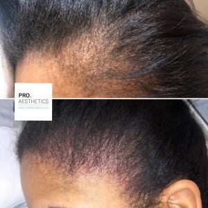 Women’s hair restoration treatment for thinning hair in Bristol