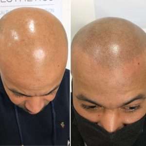 PRP hair restoration treatment for men experiencing thinning hair in Bristol