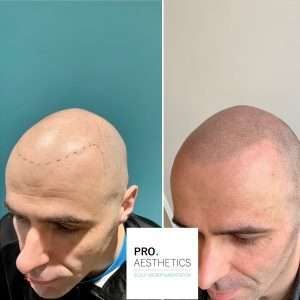 Hair restoration treatment results in Bristol