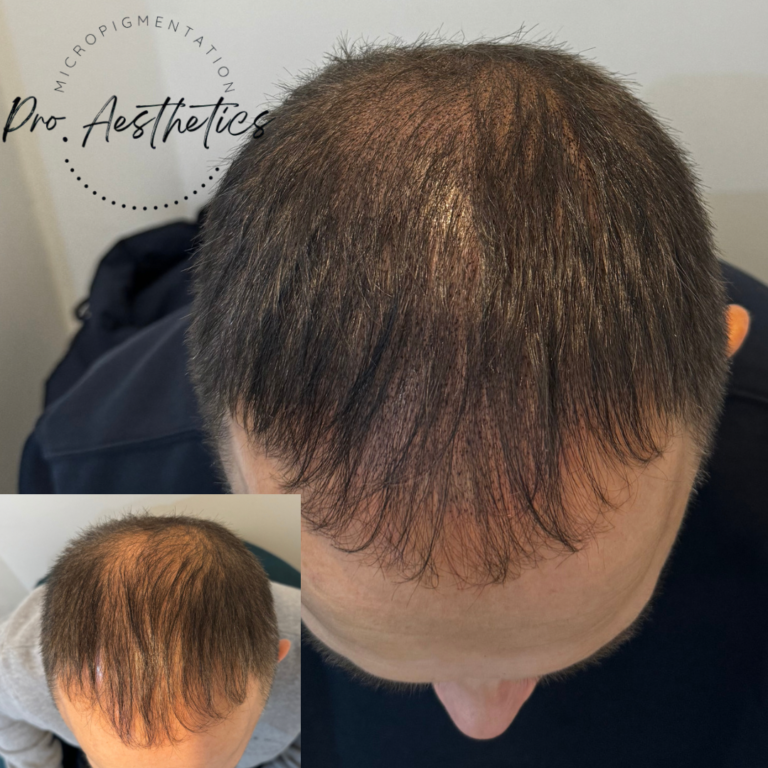 Scalp micropigmentation for hair loss in men