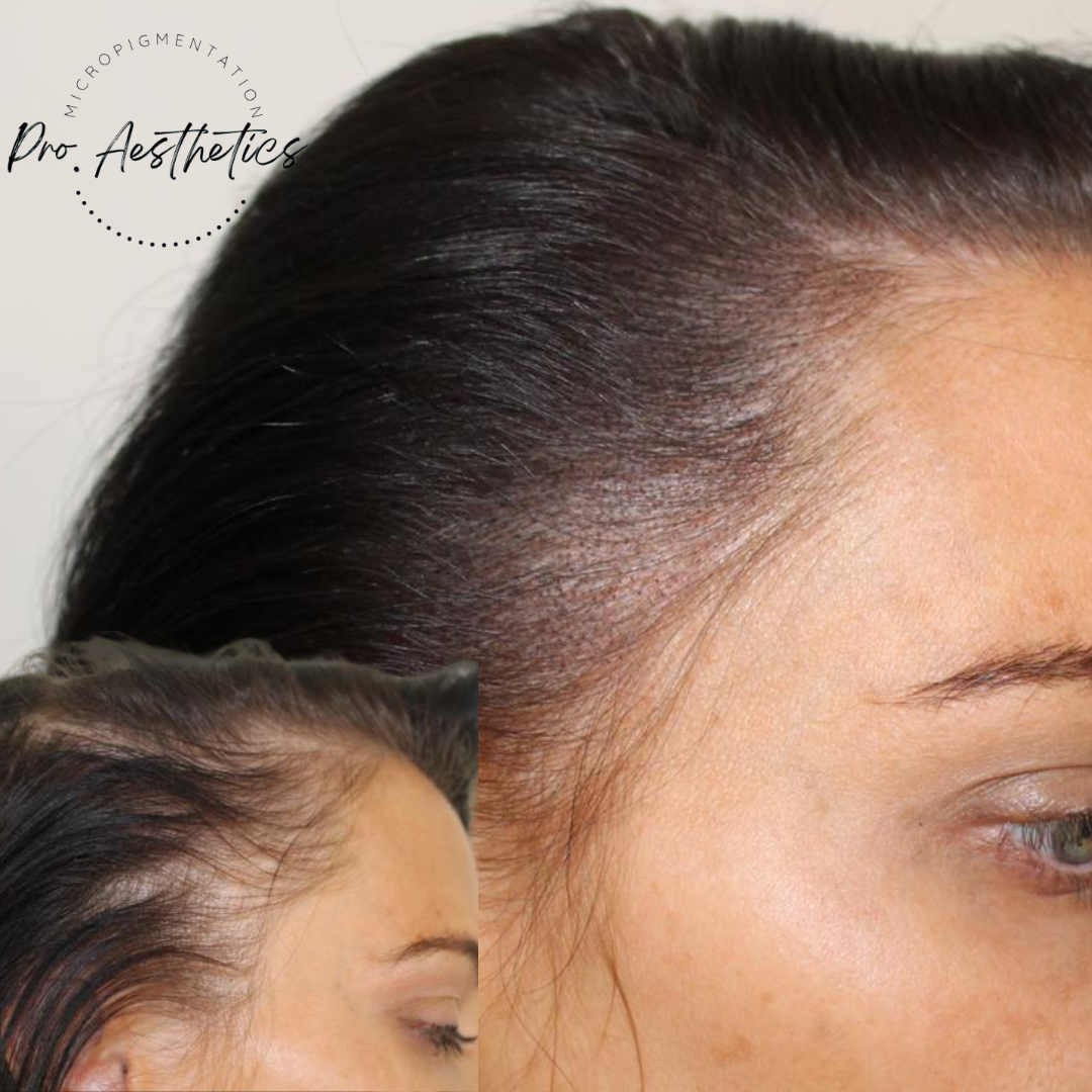Hair restoration progress results