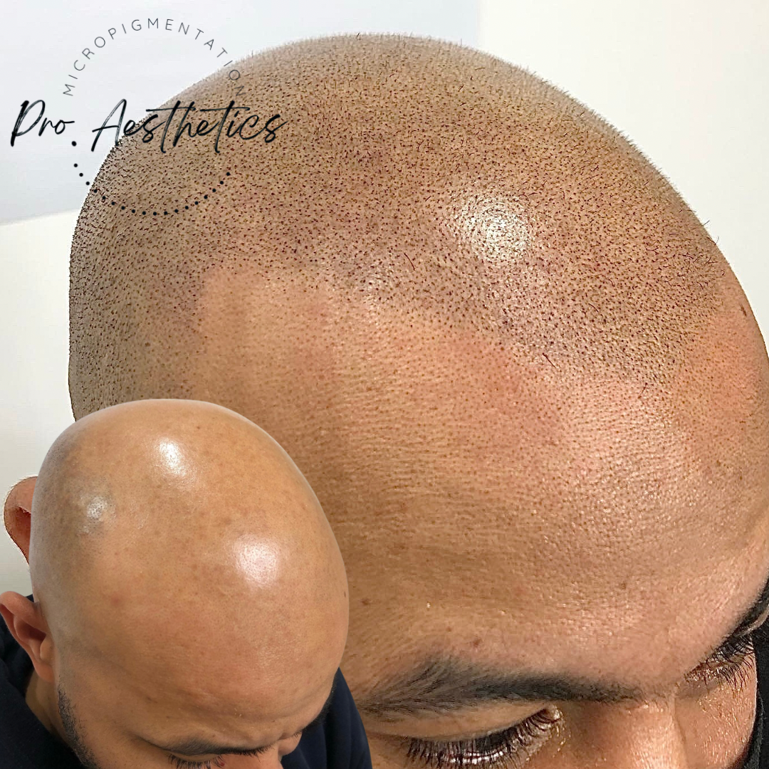 scalp micropigmentation for men