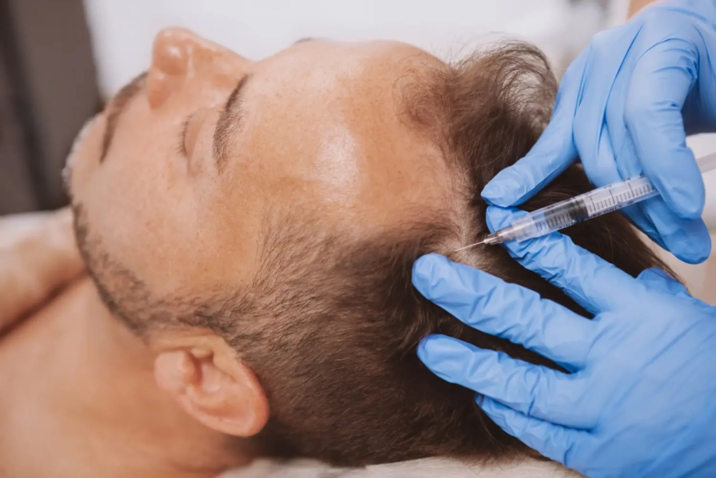 PRP scalp treatment for hair loss