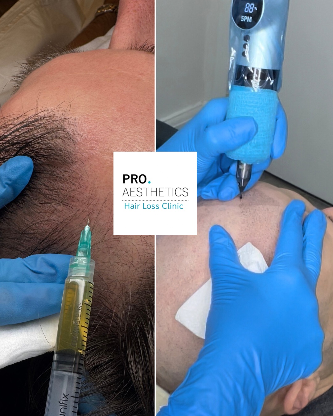 PRP injection treatment for hair loss
