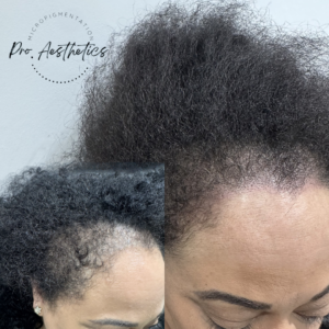 Female scalp micropigmentation before and after results