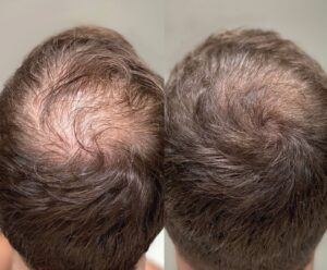 Hair loss treatment before and after results