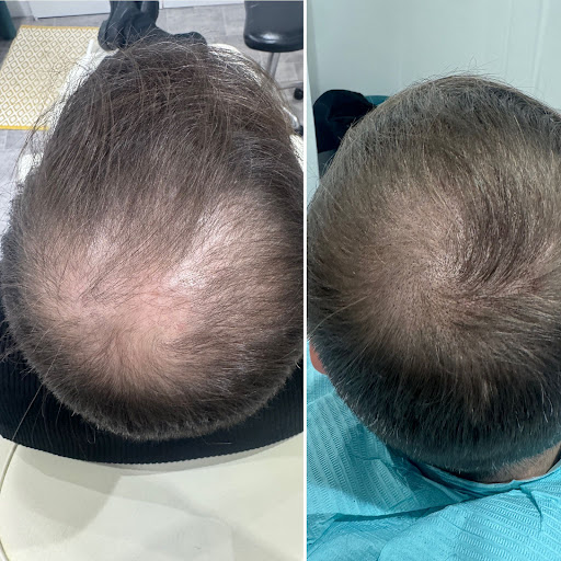 Pro. Aesthetics | Scalp Micropigmentation | Hair Clinic | Bristol Customer Review