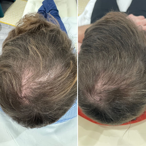 Pro. Aesthetics | Scalp Micropigmentation | Hair Clinic | Bristol Customer Review