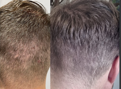 Pro. Aesthetics | Scalp Micropigmentation | Hair Clinic | Bristol Customer Review
