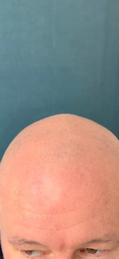 Pro. Aesthetics | Scalp Micropigmentation | Hair Clinic | Bristol Customer Review